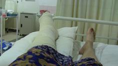 Leg in plastered and splinted by Russian orthopedic surgeon in Lusaka
